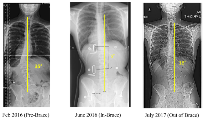 252 Scoliosis Curve Corrections Wearing the Boston Brace 3D